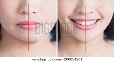 close up of surgery woman asymmetry chin before and after on the blue background