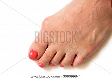 Varus Valgus And Hallux Valgus Or Bunion On Middle Aged Woman Foot. Isolated Closeup On White Backgr