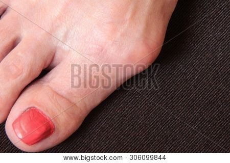 Varus Valgus And Hallux Valgus Or Bunion On Middle Aged Woman Foot. Isolated Closeup On White Backgr