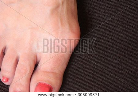 Varus Valgus And Hallux Valgus Or Bunion On Middle Aged Woman Foot. Isolated Closeup On White Backgr