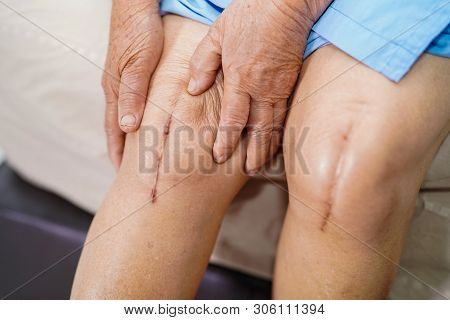 Asian Senior Or Elderly Old Lady Woman Patient Show Her Scars Surgical Total Knee Joint Replacement 