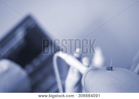 Epi Dry Needling Ultrasound Scan