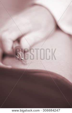 Epi Needling Physical Therapy