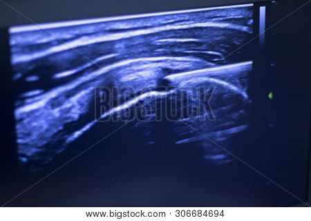 Epi Dry Needling Ultrasound Scan