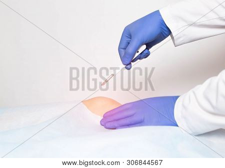 Doctor Surgeon With A Scalpel In His Hand Makes An Incision In The Knee Joint. Concept Of Joint Repl