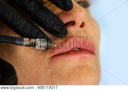 Procedure Augmentation. Syringe Hyaluronic Acid Injection, Augmentation. Age Changes. Cosmetology Tr