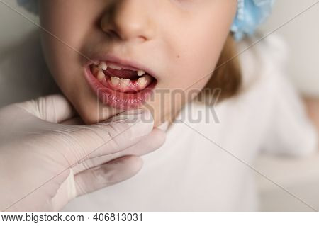 A Dentist Examines The Baby Teeth In The Girl. The Loss Of Milk Teeth. The Girl Has No Upper Teeth. 