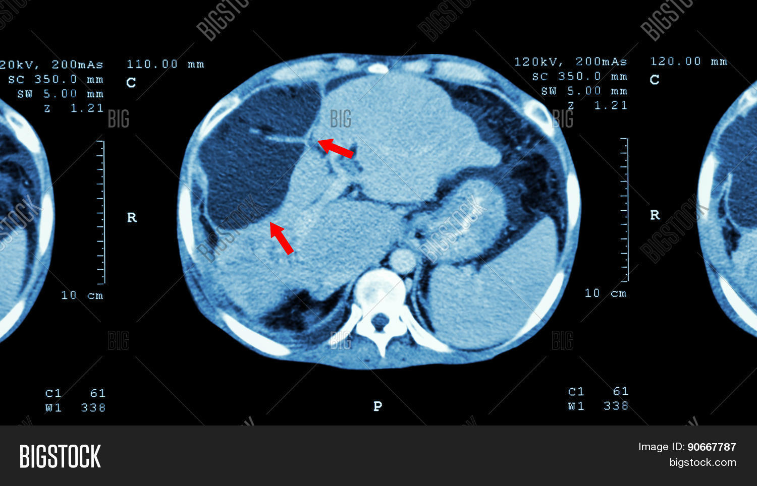 Ct Scan Upper Abdomen Image & Photo (Free Trial) Bigstock
