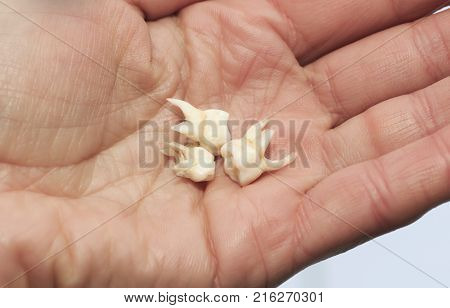 pull the three children's milk tooth are clearly visible