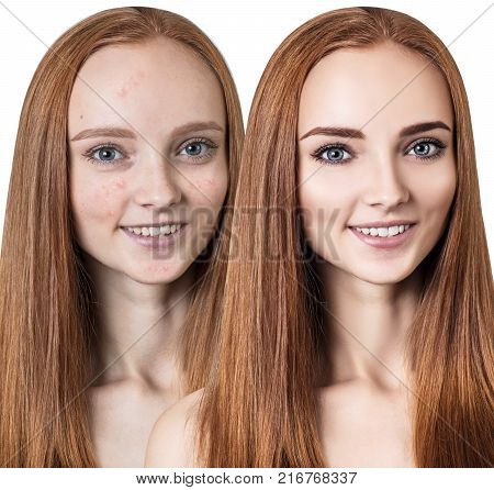Comparison portrait of young girl with acne before and after treatment and make-up.