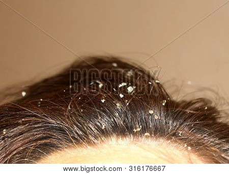 Dandruff On The Hair. Hair Disease Seborrhea. Fatty Dandruff.
