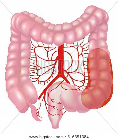 Ulcerative Colitis, Human Body. 3d Illustration Transparent Png Images.