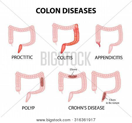 Colon Diseases. Proctitis, Colitis, Appendicitis, Polyp, Ulcer, Crohns Disease. Infographics. Illust