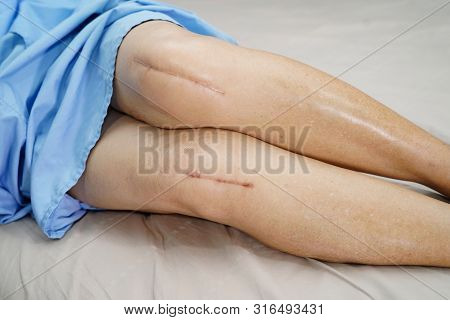 Asian Senior Or Elderly Old Lady Woman Patient Show Her Scars Surgical Total Knee Joint Replacement 