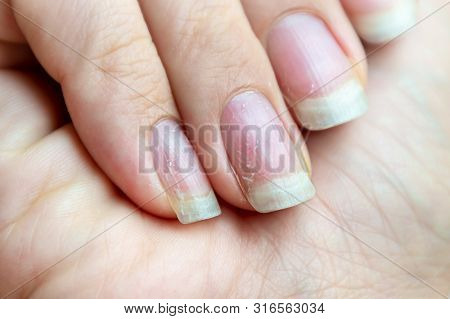 Damaged Nails That Have Problem After Doing Manicure. Health And Beauty Problem