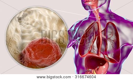 Esophageal Cancer, 3d Illustration Showing Malignant Tumor In The Human Esophagus