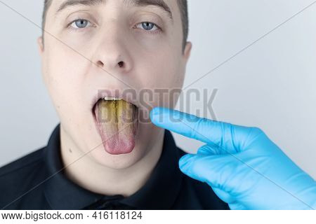 The Man Has A Yellow Tongue. Painful Yellow Coating On The Mucous Membrane Of The Tongue. Diseases O