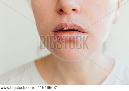 Close Up Of Girl Lips Affected By Herpes. Treatment Of Herpes Infection And Virus. Part Of Young Wom