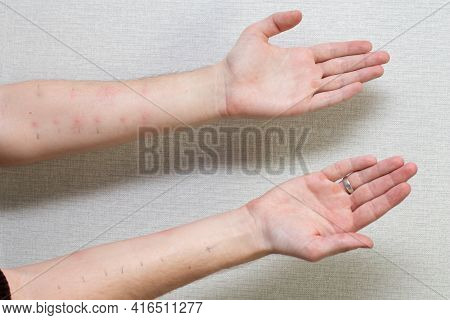 Male Hands With Positive Allergy Tests. Allergy Tests On The Arms