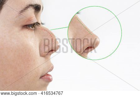 Rhinoplasty. Female Face Close-up Showing The Result Before And After Rhinoplasty. Side View. White 