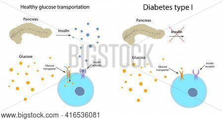 Diabetes Type 1 And Healthy Transportation Comparison. Pancreas, Insulin Receptor, Glucose Transport