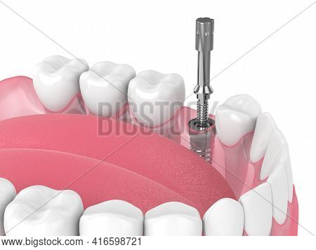 3D Render Of Dental Implant With Multipeg To Check Implant Stability