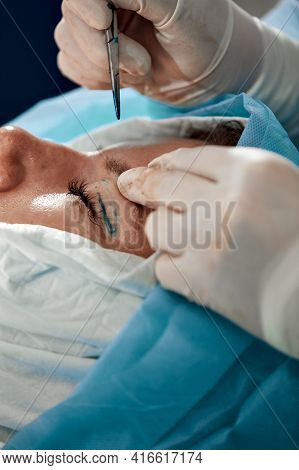 Close Up Of The Face Of A Patient Undergoing Blepharoplasty. The Surgeon Cuts The Eyelid And Perform
