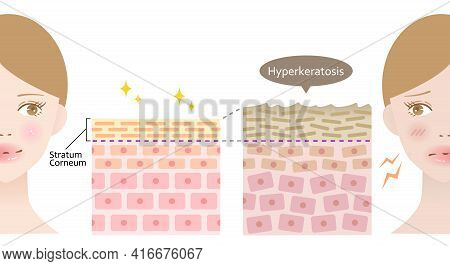 Diagram Of Thickening Of The Stratum Corneum And Woman Face.beauty Treatment  Before After Illustrat