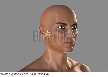 Otitis Media In An African Man, A Group Of Inflammatory Diseases Of The Middle Ear, 3d Illustration