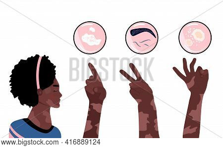 World Vitiligo Day.young Afro American Woman With Skin Disease.hands Show 1,2,3 Fingers. Pigmentatio