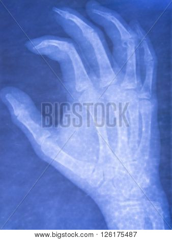 film x-ray both hand AP : show normal human's hands on black background (isolated)