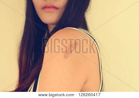 Skin lesions from allergies. Vintage filtered image.
