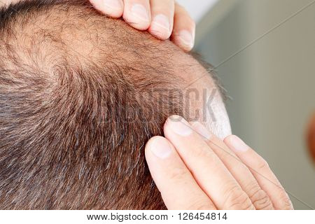 Hair loss.
