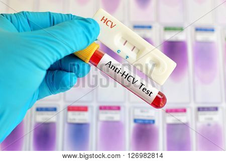 Anti -HCV testing by using test cassette, the result showed positive (double red line)