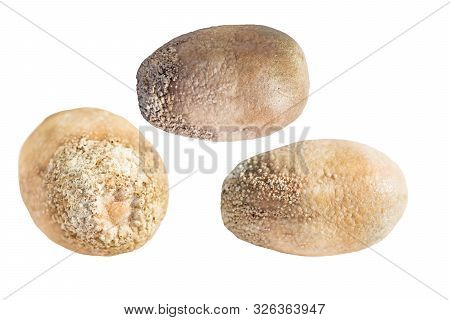 Larger Stone Size Of 4 Cm From The Gallbladder, Removed After Surgery Cholecystectomy, Gallstone Dis