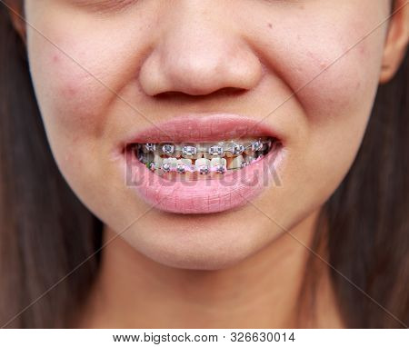 Braces To Treat Symptoms Prognathism