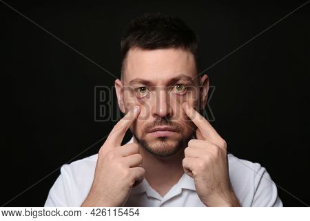 Man Checking His Health Condition On Black Background. Yellow Eyes As Symptom Of Problems With Liver