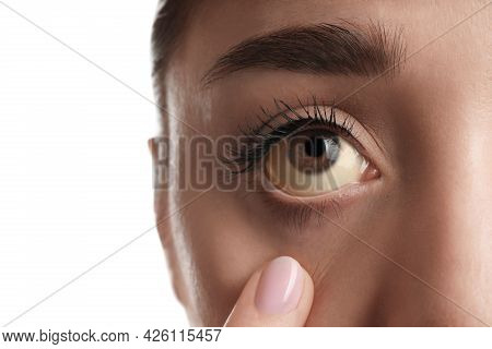 Woman Checking Her Health Condition On White Background, Closeup. Yellow Eyes As Symptom Of Problems