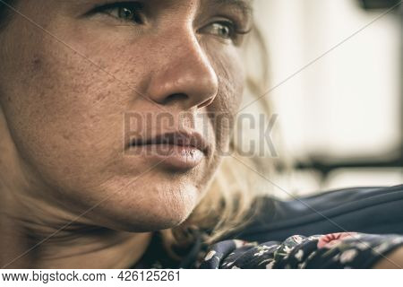 Close-up Side Portrait Young Woman Real Problem Face Skin Cheek Acne Icepick Scar Big Open Hole Pore