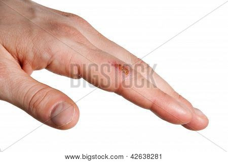 Wunde am finger