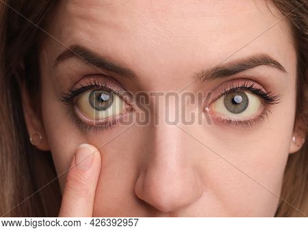 Woman Checking Her Health Condition On White Background, Closeup. Yellow Eyes As Symptom Of Problems