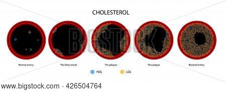 Cholesterol In Human Blood Vessels. Fat 3d Cells In Vein And Artery. High Ldl And Hdl Level. Blocked