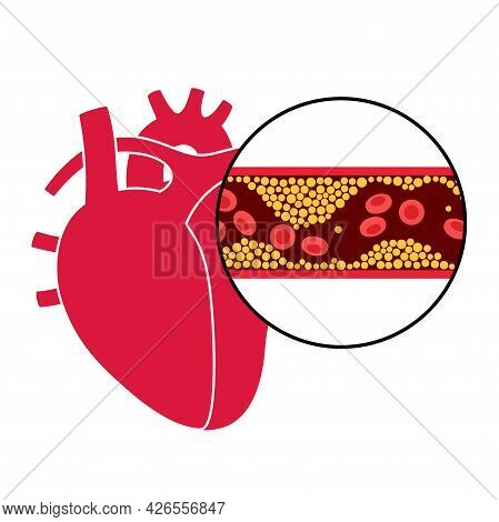 Cholesterol In Human Blood Vessels And Heart Logo. Fat Cells In Vein Arteries. High Ldl And Hdl Leve
