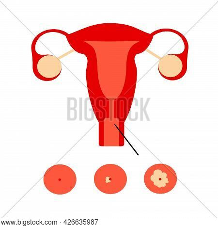 Illustration Of Uterus With Cervical Cancer. Stages Of Cervical Cancer. Cancer. Violation Of The Rep