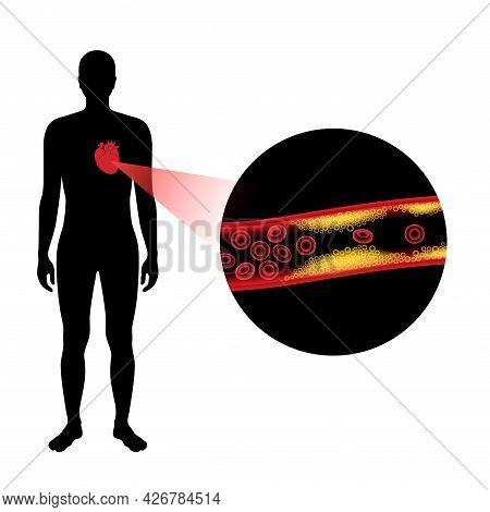 Cholesterol In Human Blood Vessels. Heart Logo In Man Silhouette. Fat Cells In Vein. High Ldl And Hd