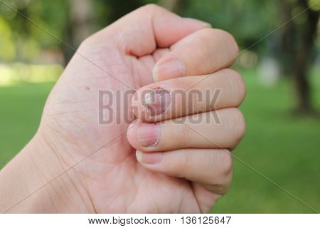 Finger With Onychomycosis. A Toenail Fungus.. - Soft Focus