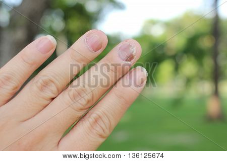 Finger With Onychomycosis. A Toenail Fungus.. - Soft Focus