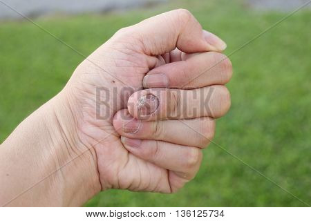 Finger With Onychomycosis. A Toenail Fungus.. - Soft Focus