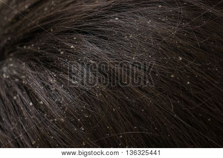 White Dandruff Flakes In Dry Hair On Head.