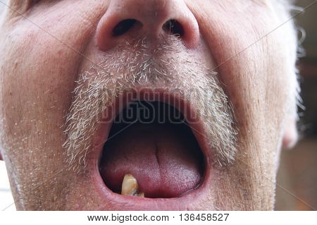 The Mouth of the person with sick teeth.Open mouth without teeth